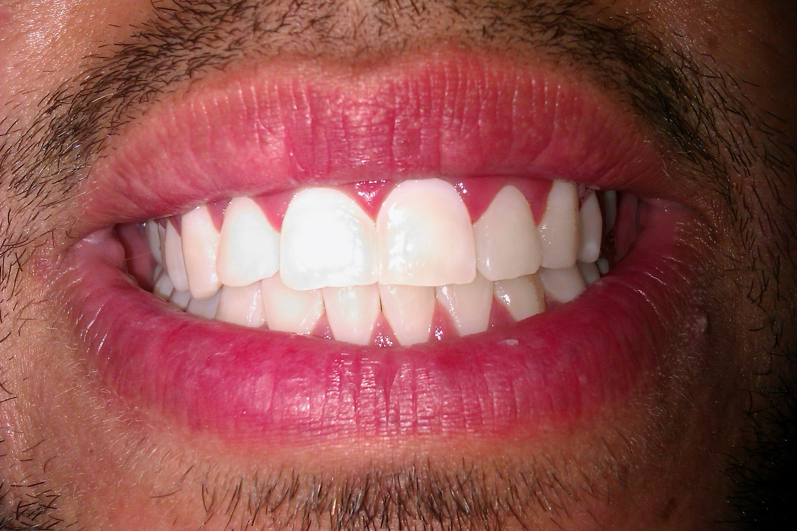 teeth whitening after